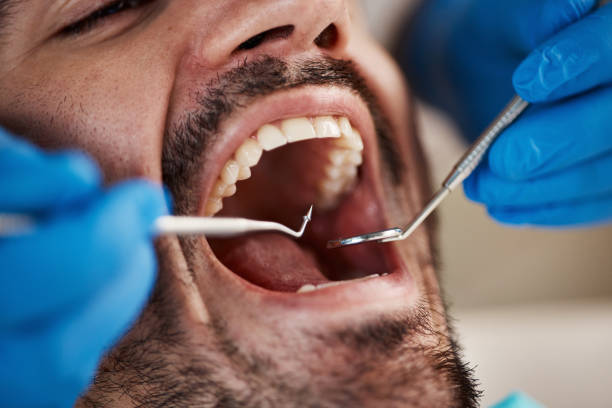 Best Emergency Tooth Extraction in Sandy Springs, GA