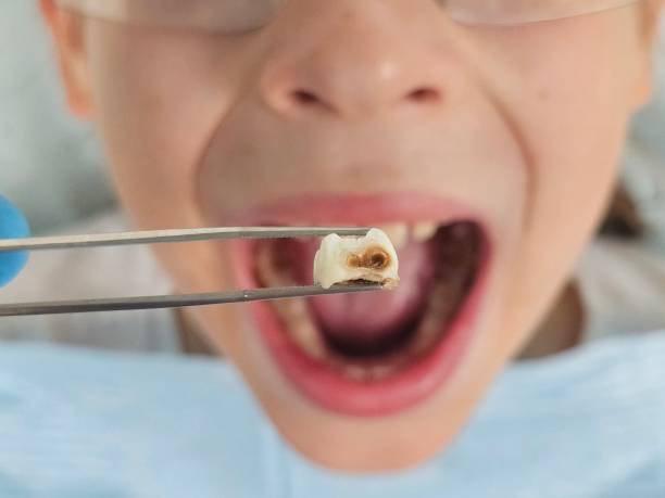 Best Emergency Dental Care for Broken or Chipped Teeth in Sandy Springs, GA